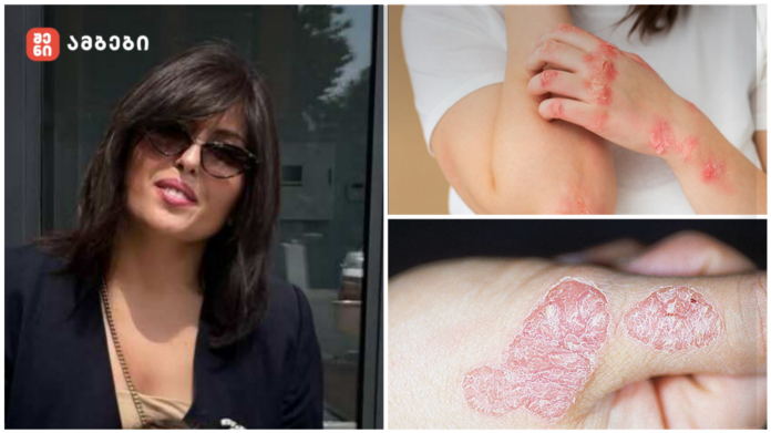 როცა ექიმბაშობა საფრთხეა❗️ ფსორიაზის მართვა პაციენტის გამოცდილებით – ინტერვიუ ქეთი ფირცხალავასთან